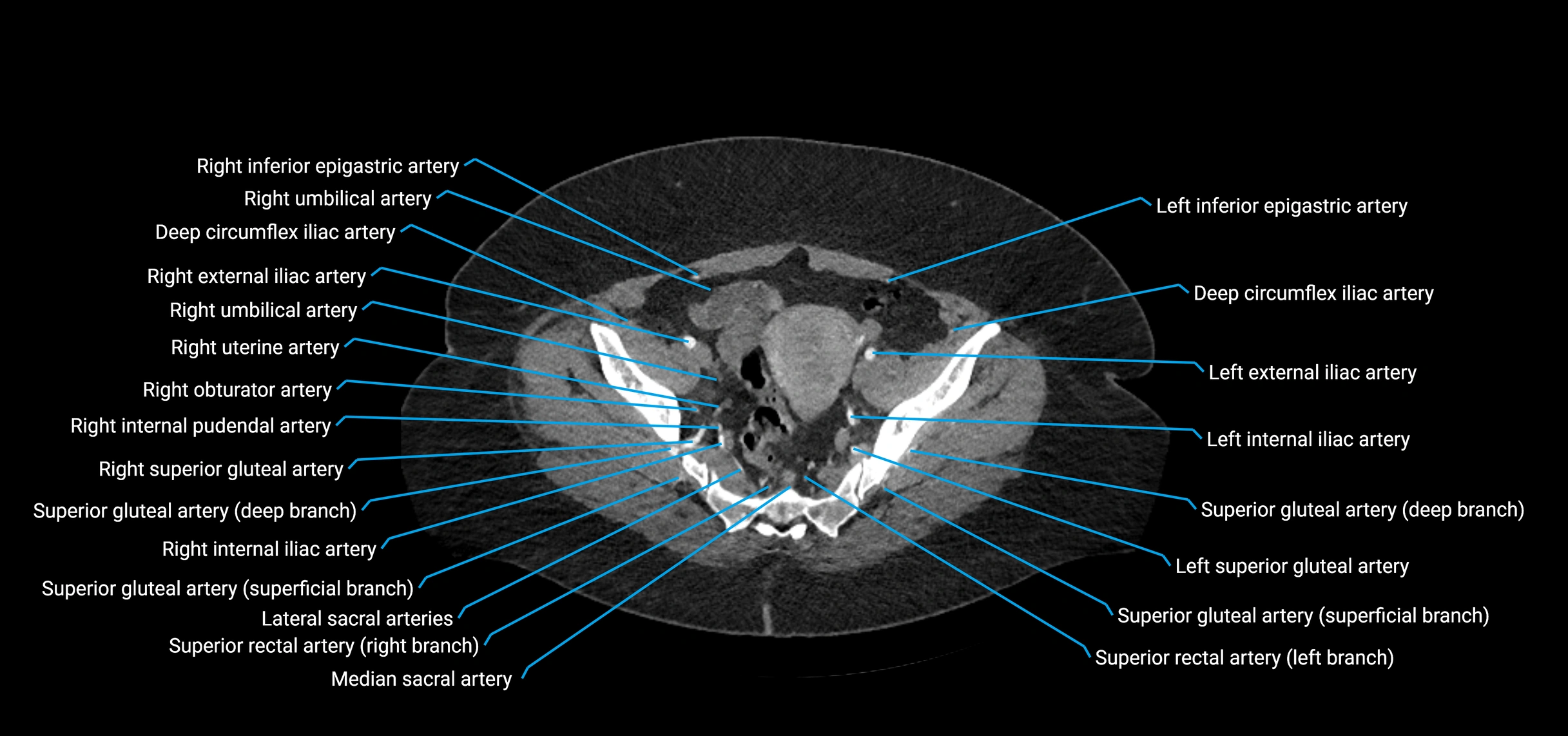 CTA abdomen axial cross sectional anatomy labelled image_211 (2).webp
